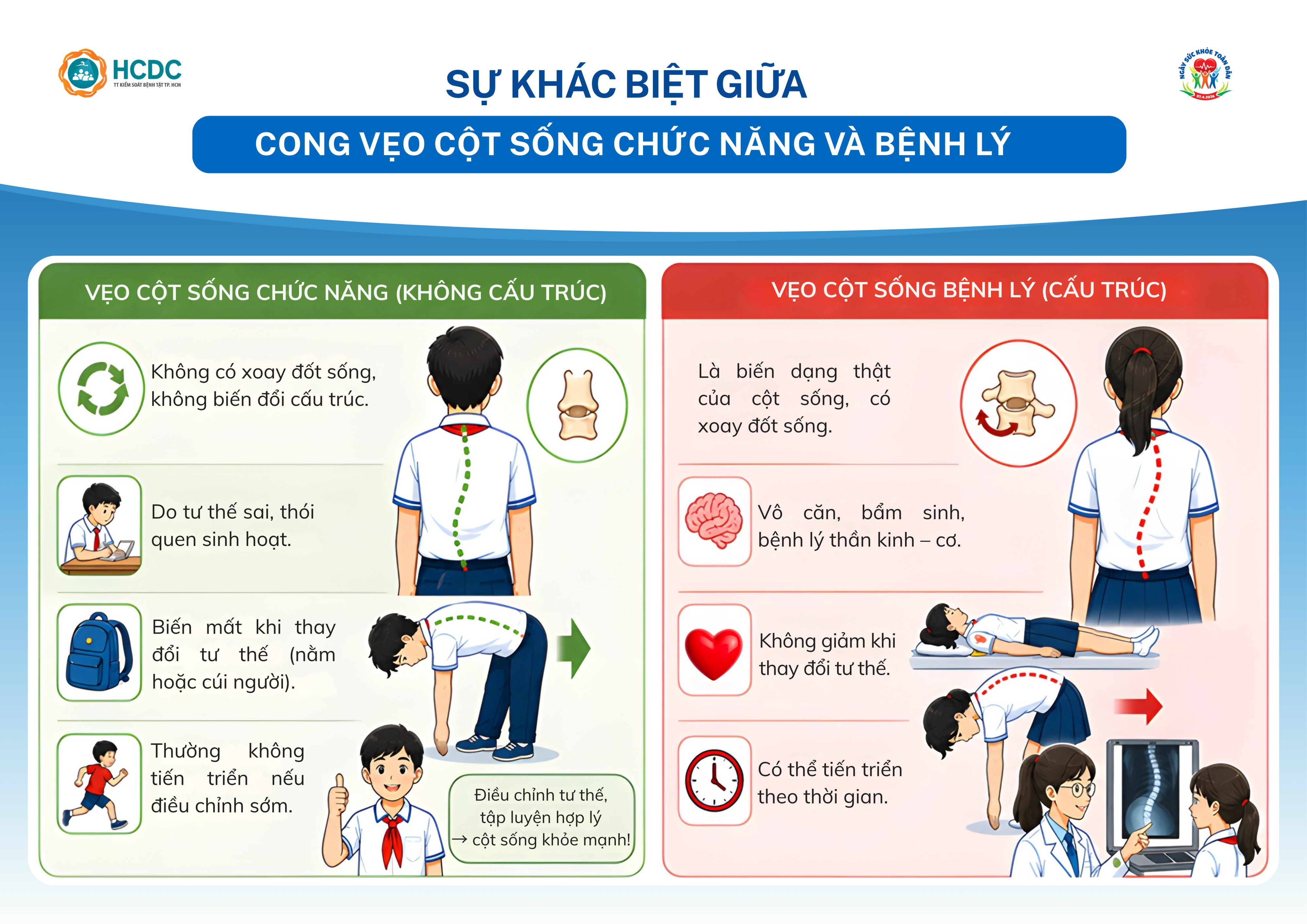 Infographic: Sự khác biệt giữa cong vẹo cột sống chức năng và bệnh lý