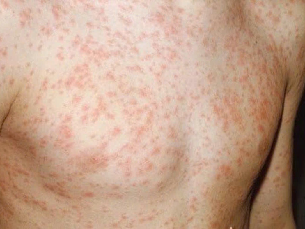 Hướng dẫn cách ly đối với bệnh sởi (Hỏi đáp về bệnh sởi – phần 3)