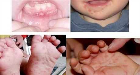 Bệnh Tay chân miệng: nhận diện và chăm sóc trẻ bệnh