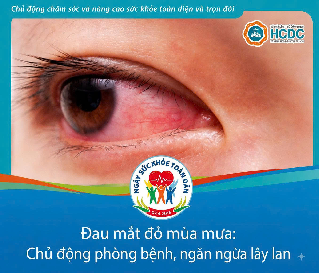 Đau mắt đỏ mùa mưa: Chủ động phòng bệnh, ngăn ngừa lây lan